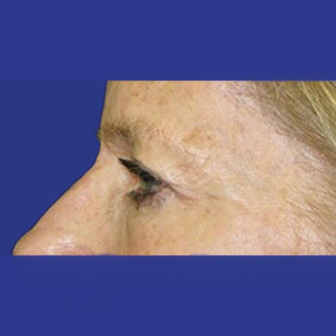 Procedure before and after - before