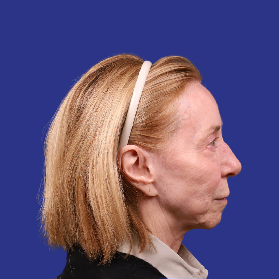 Procedure before and after - before