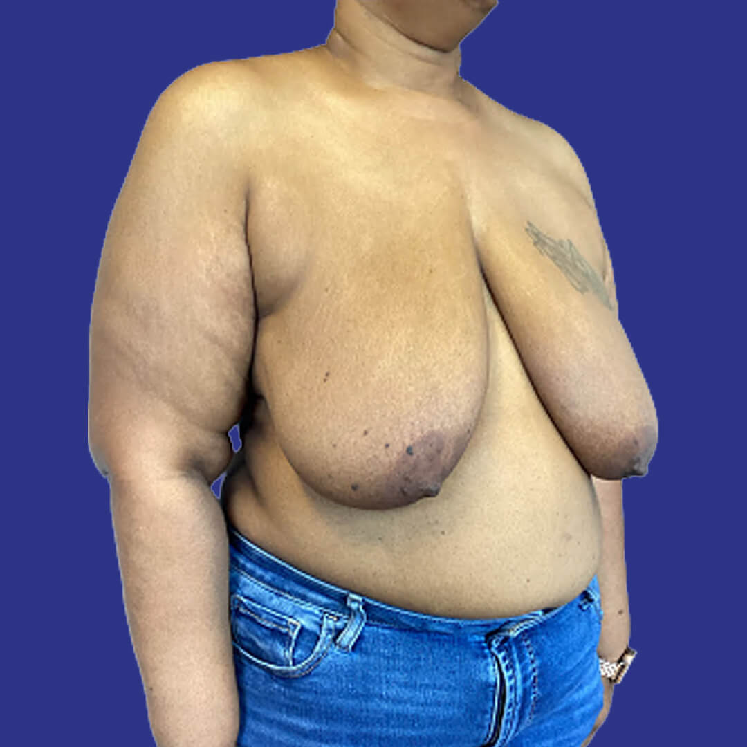 Procedure before and after - before
