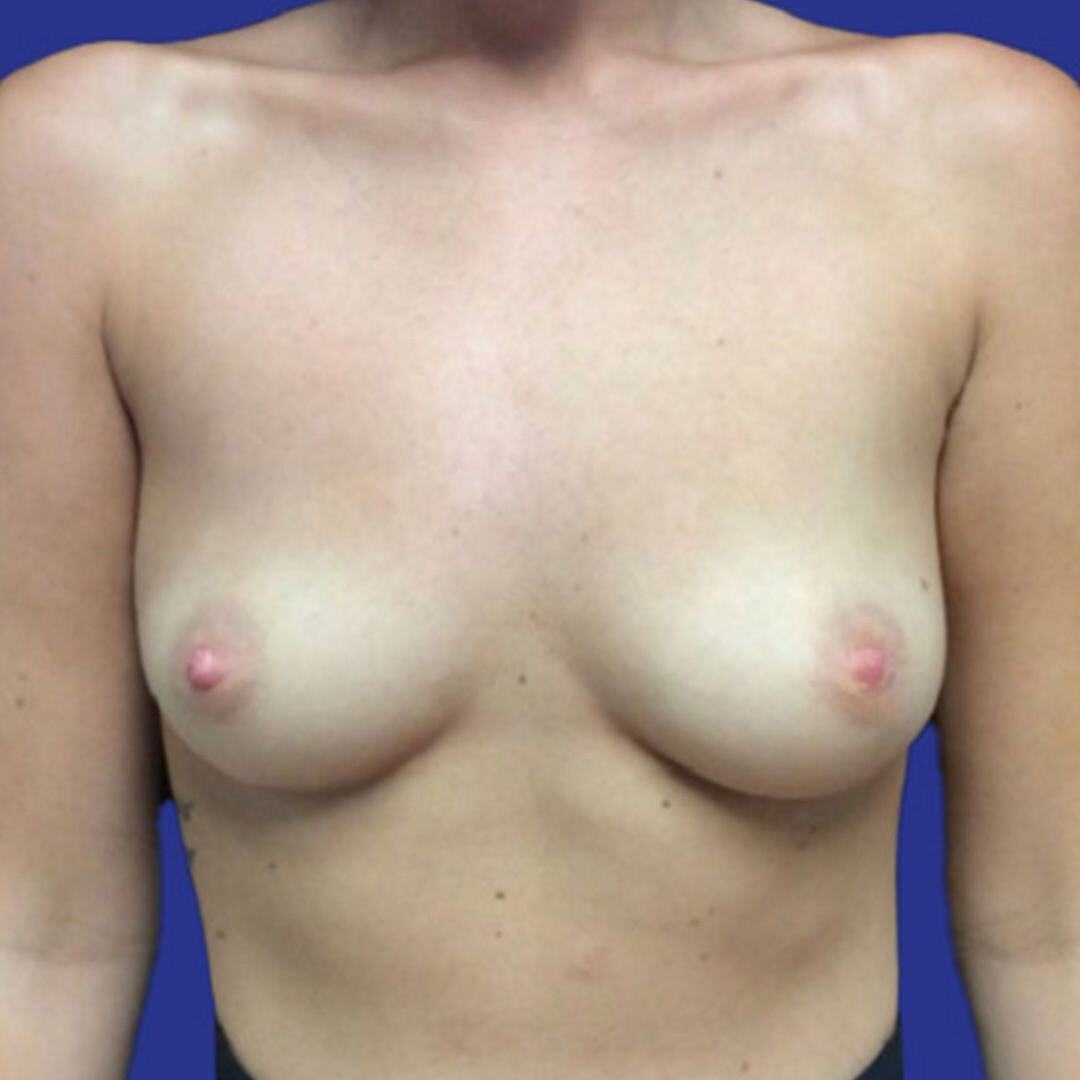 Procedure before and after - before
