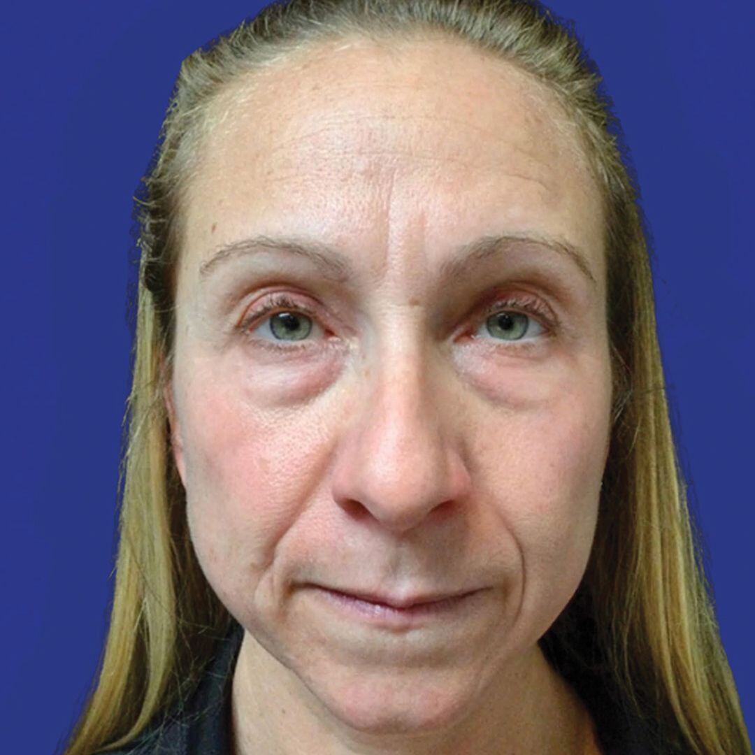 Procedure before and after - before