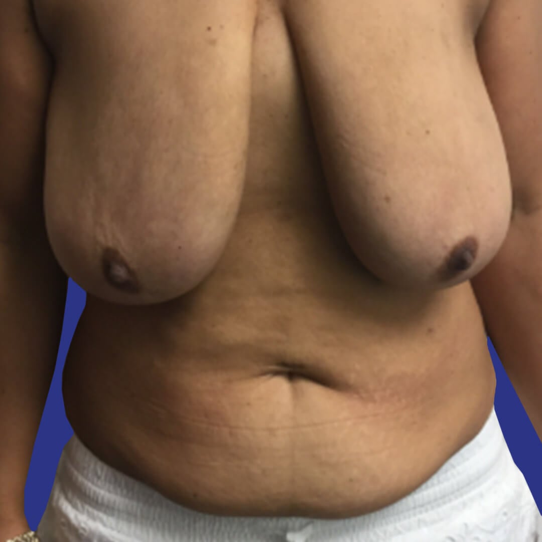 Procedure before and after - before
