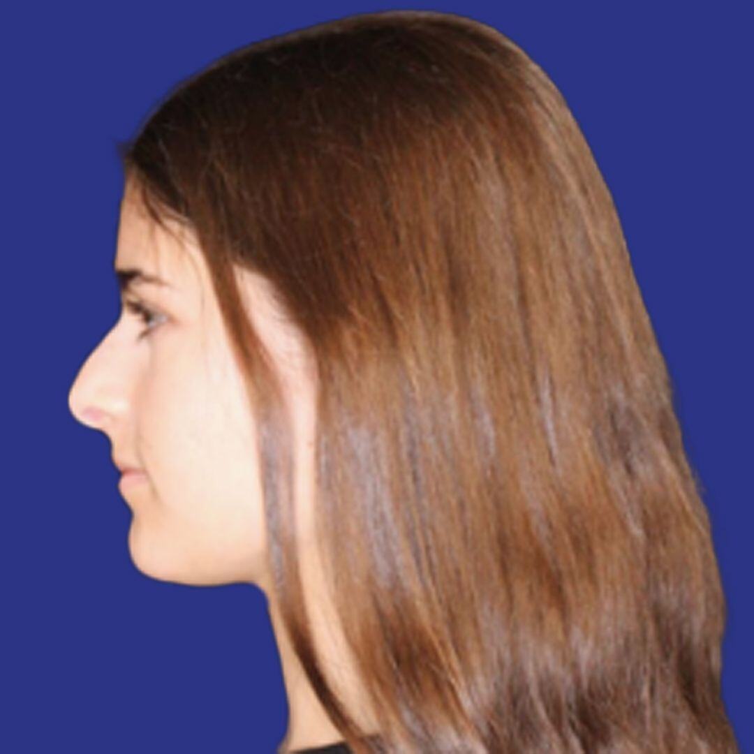 Procedure before and after - before