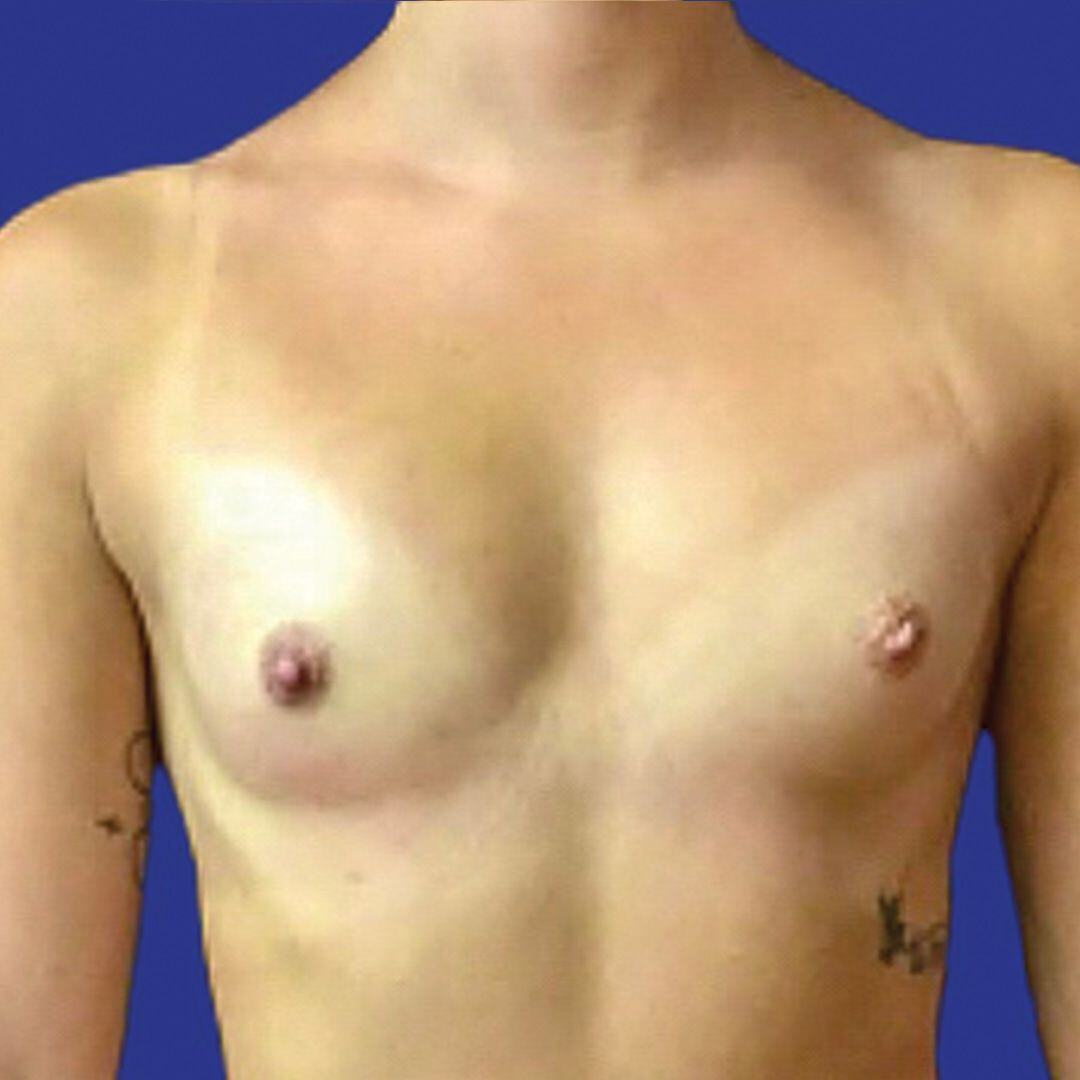 Procedure before and after - before
