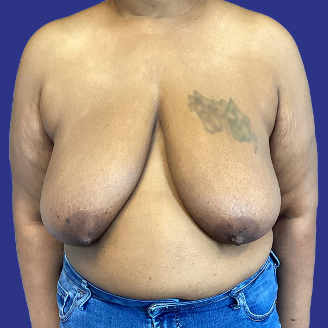 Procedure before and after - before