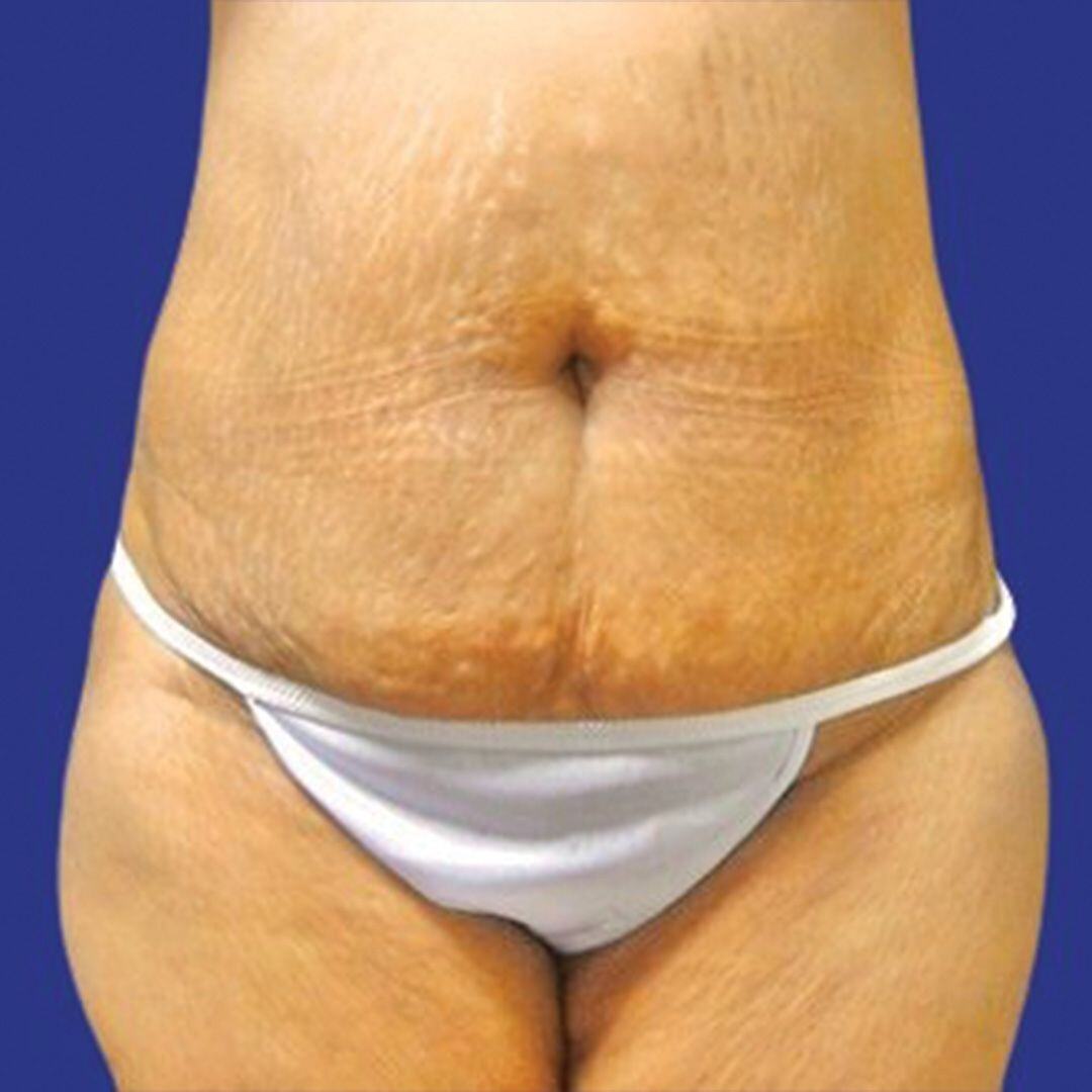 Procedure before and after - before