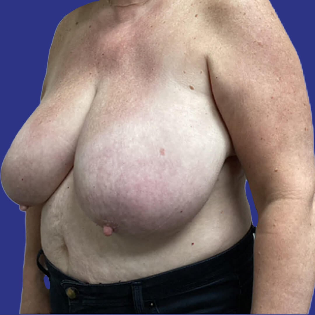 Procedure before and after - before