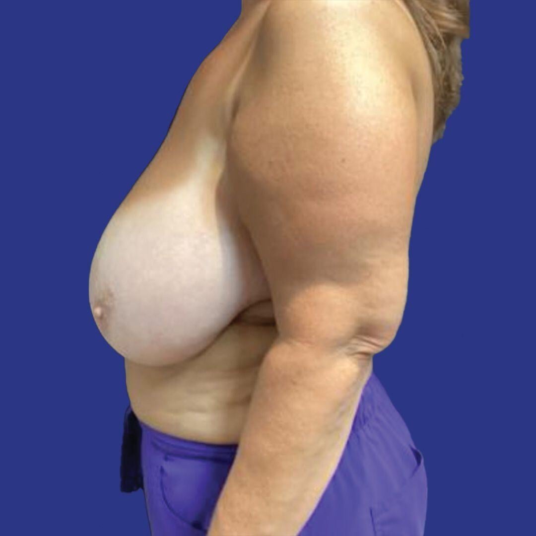 Procedure before and after - before