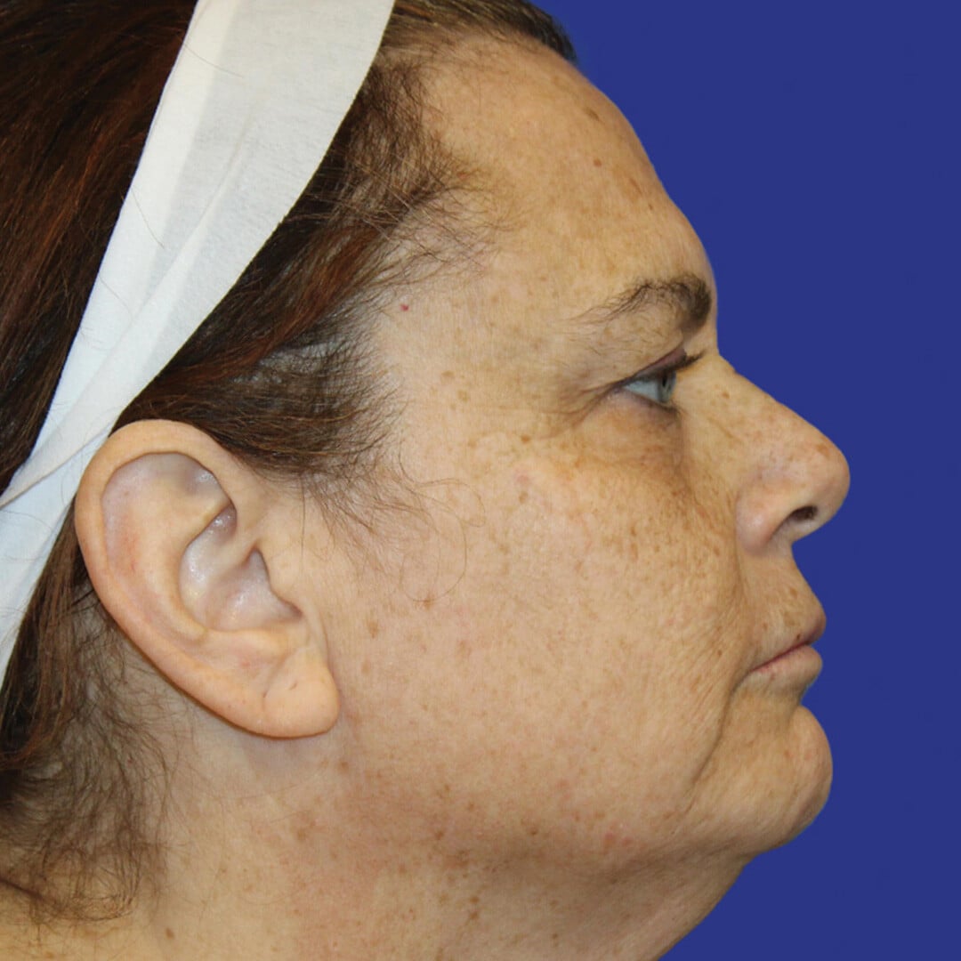 Procedure before and after - before