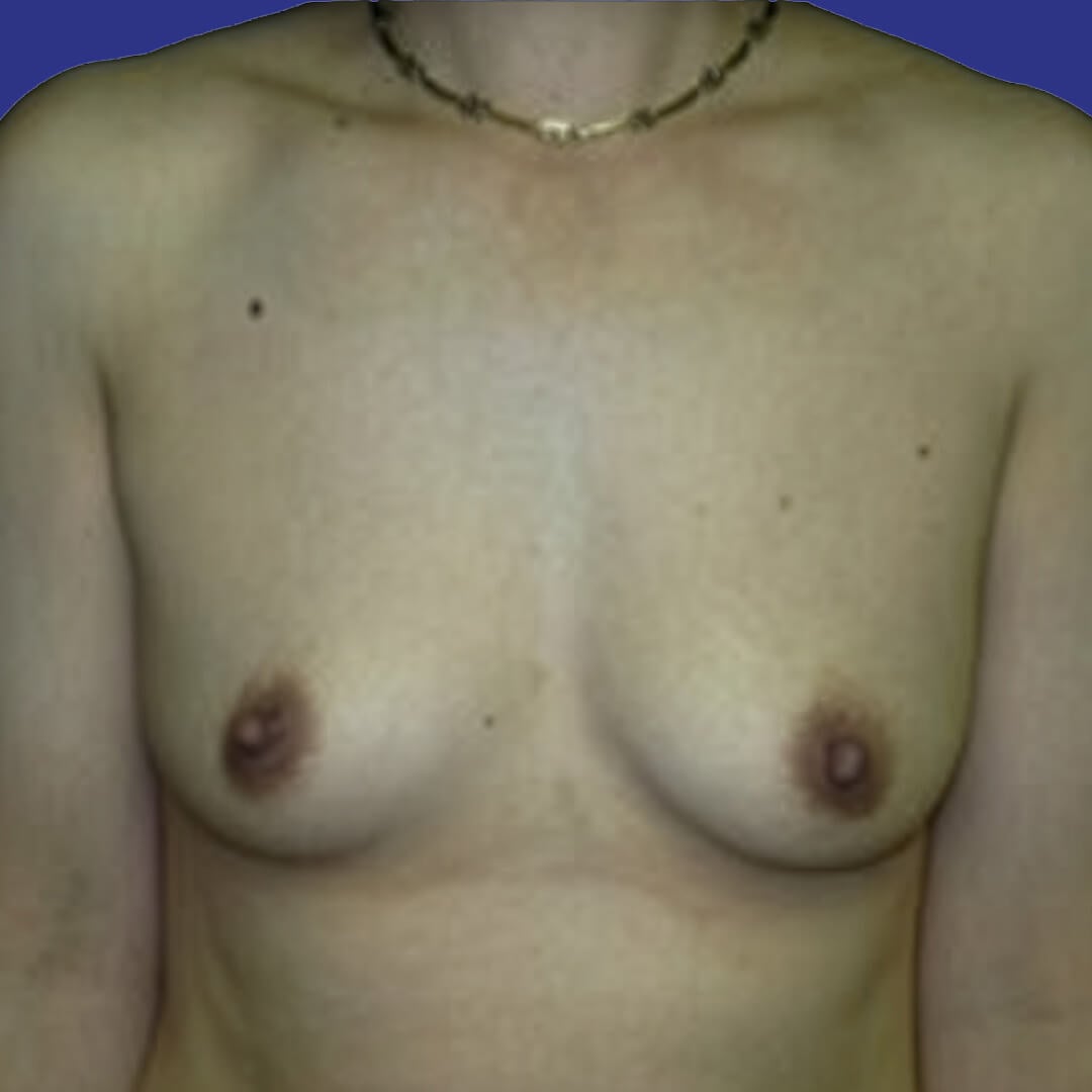 Procedure before and after - before