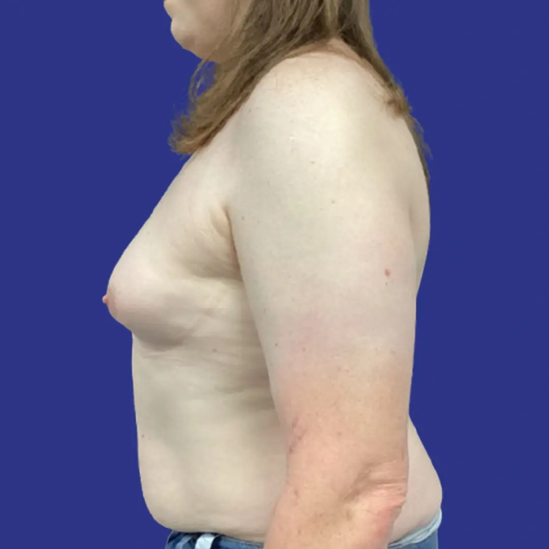 Procedure before and after - before
