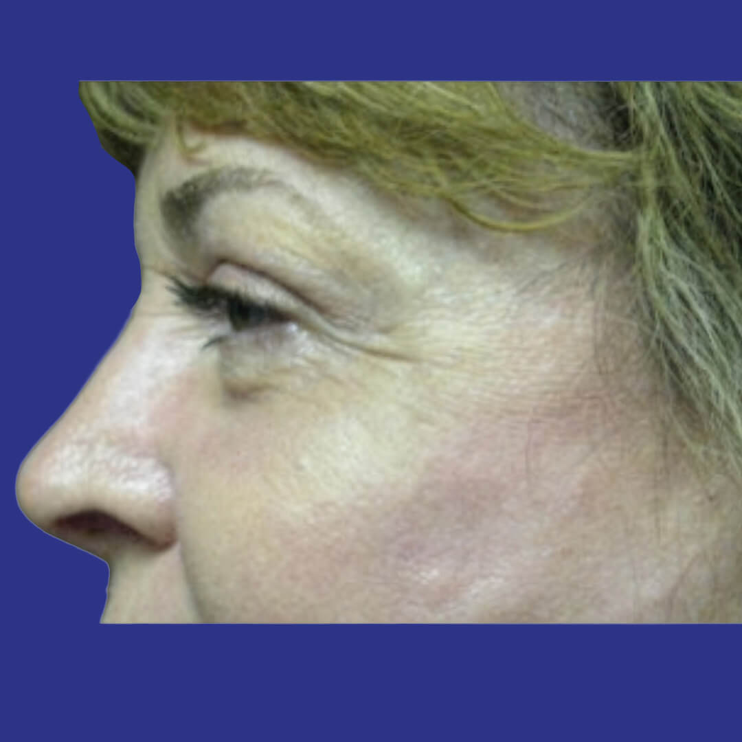 Procedure before and after - before