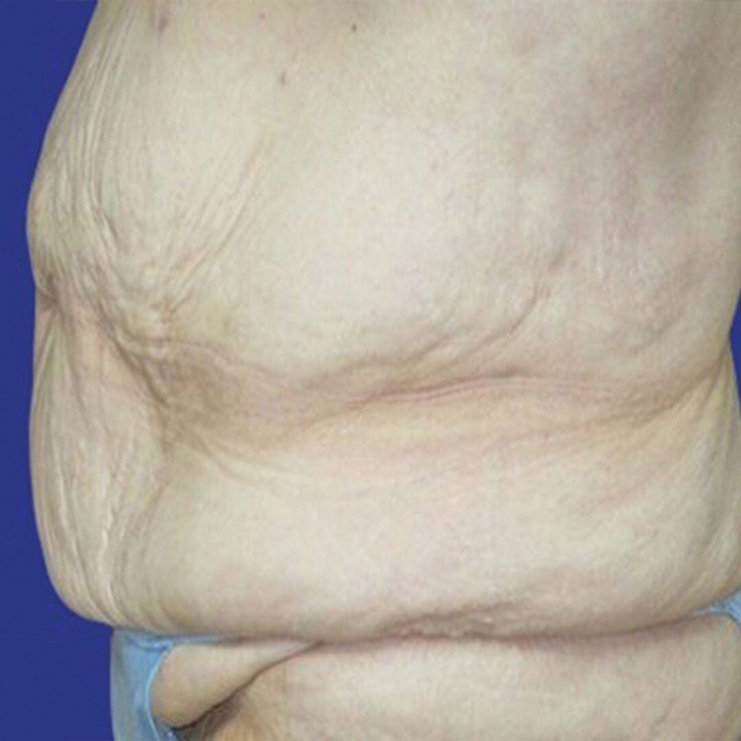 Procedure before and after - before