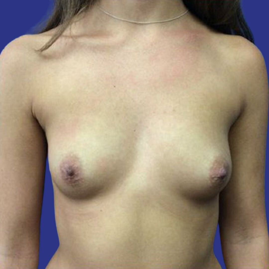 Procedure before and after - before
