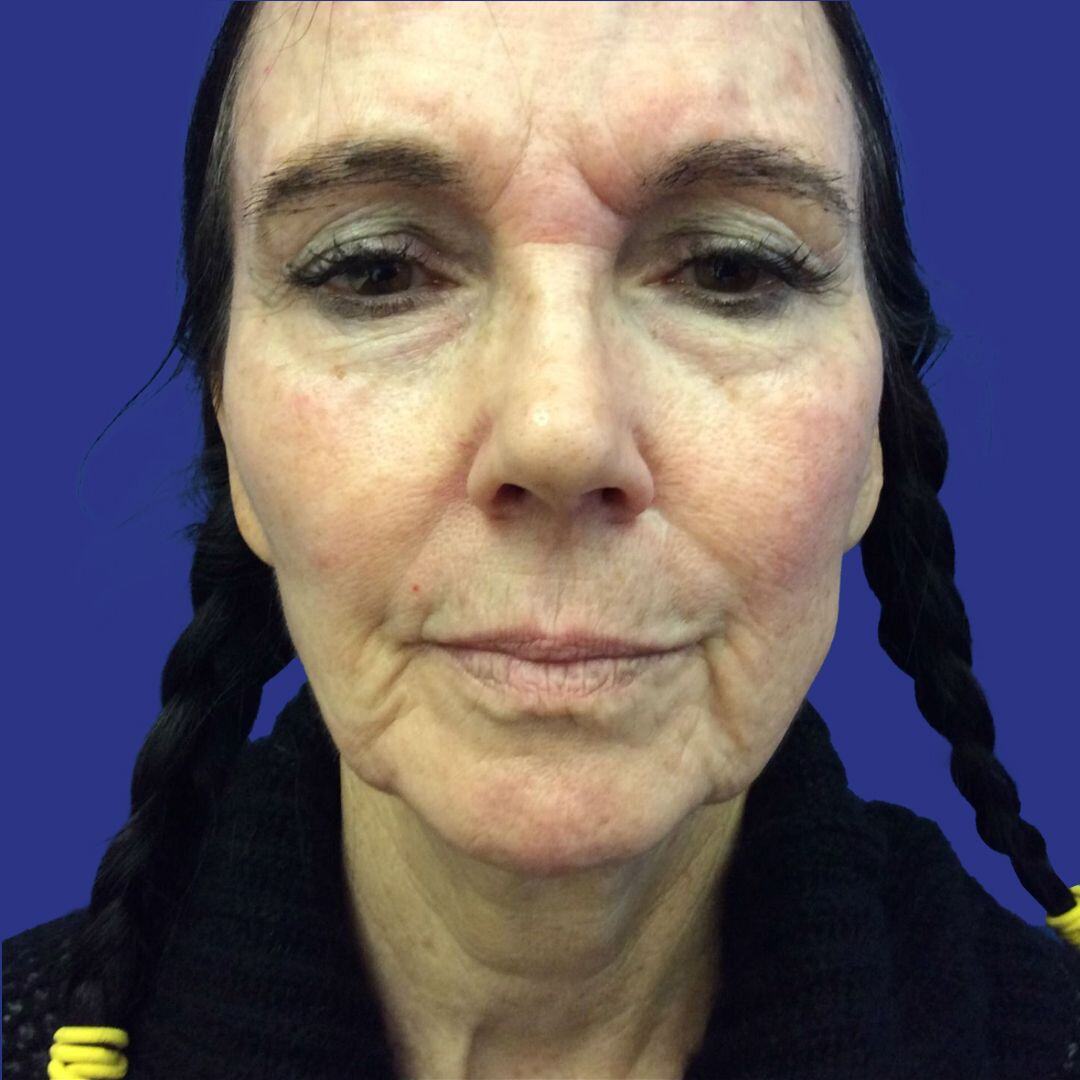 Procedure before and after - before