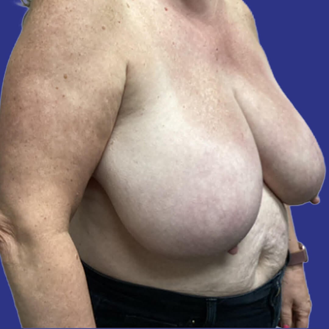 Procedure before and after - before