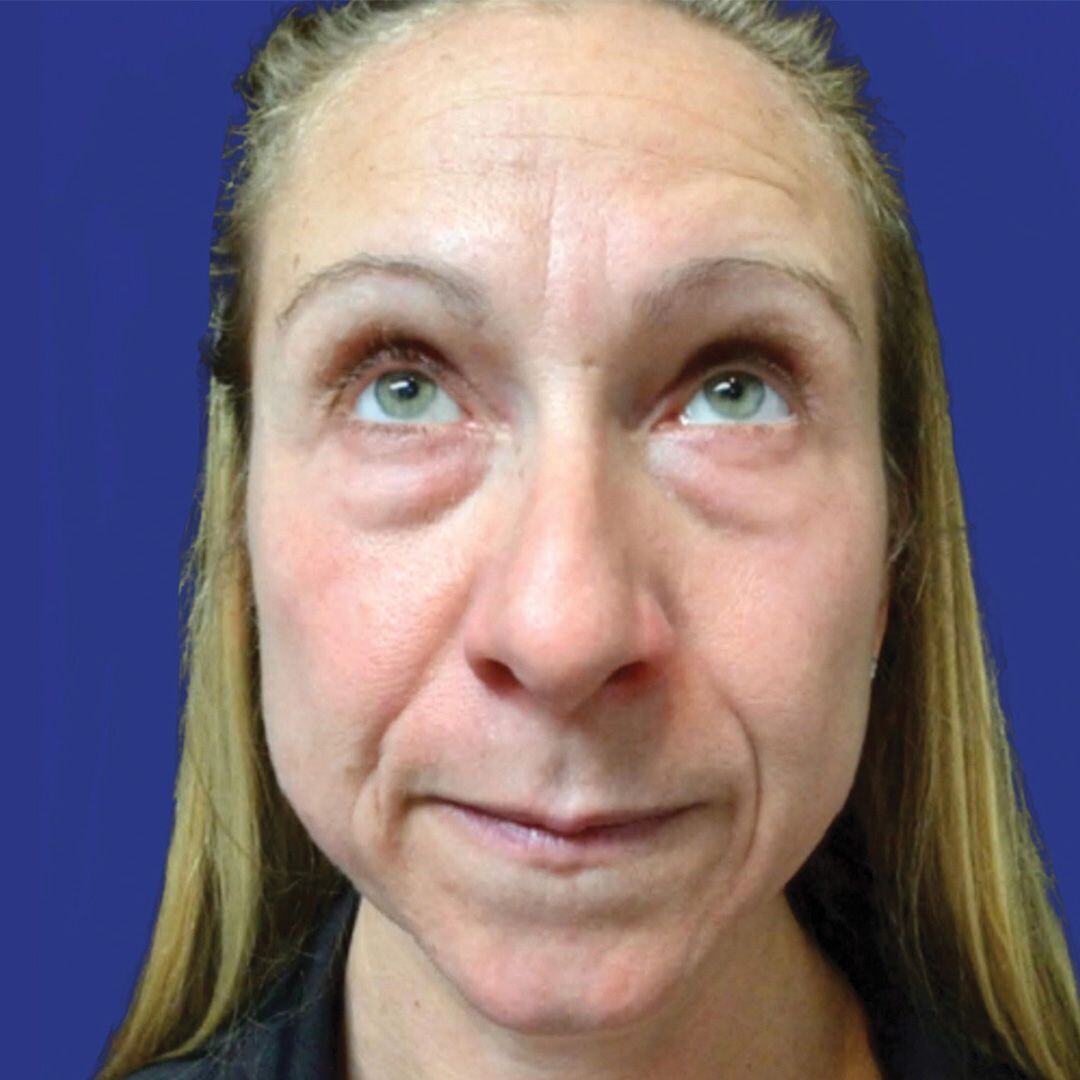 Procedure before and after - before