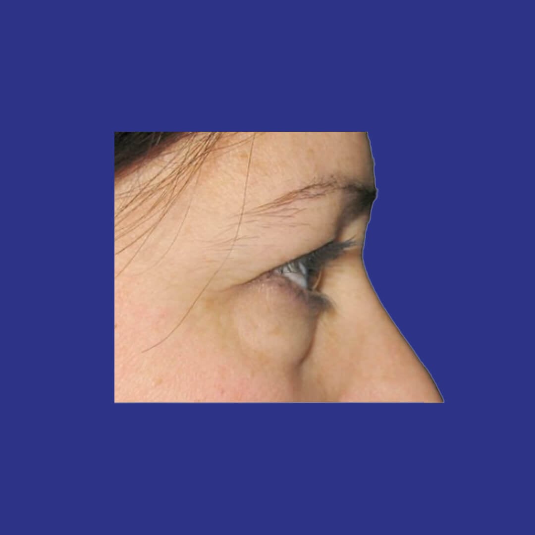 Procedure before and after - before