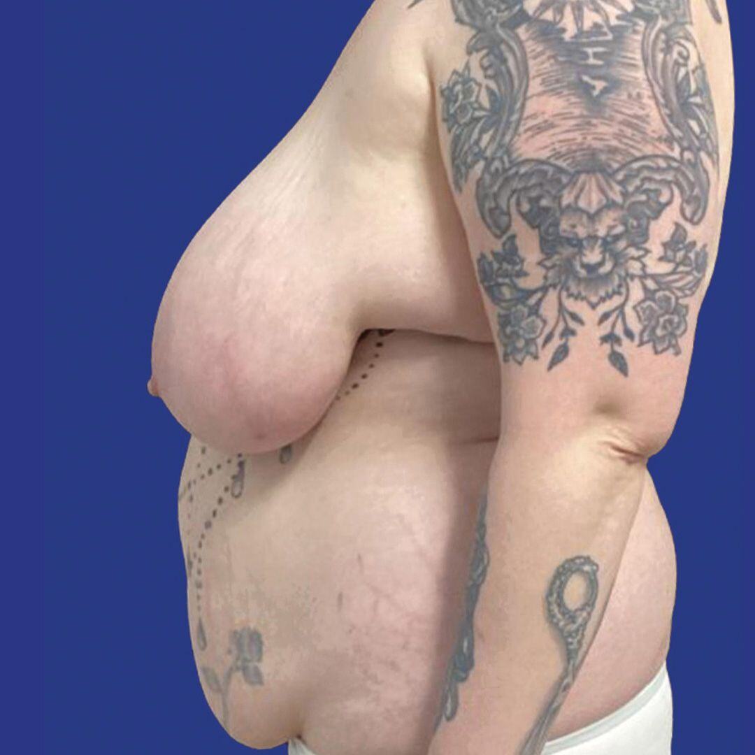 Procedure before and after - before