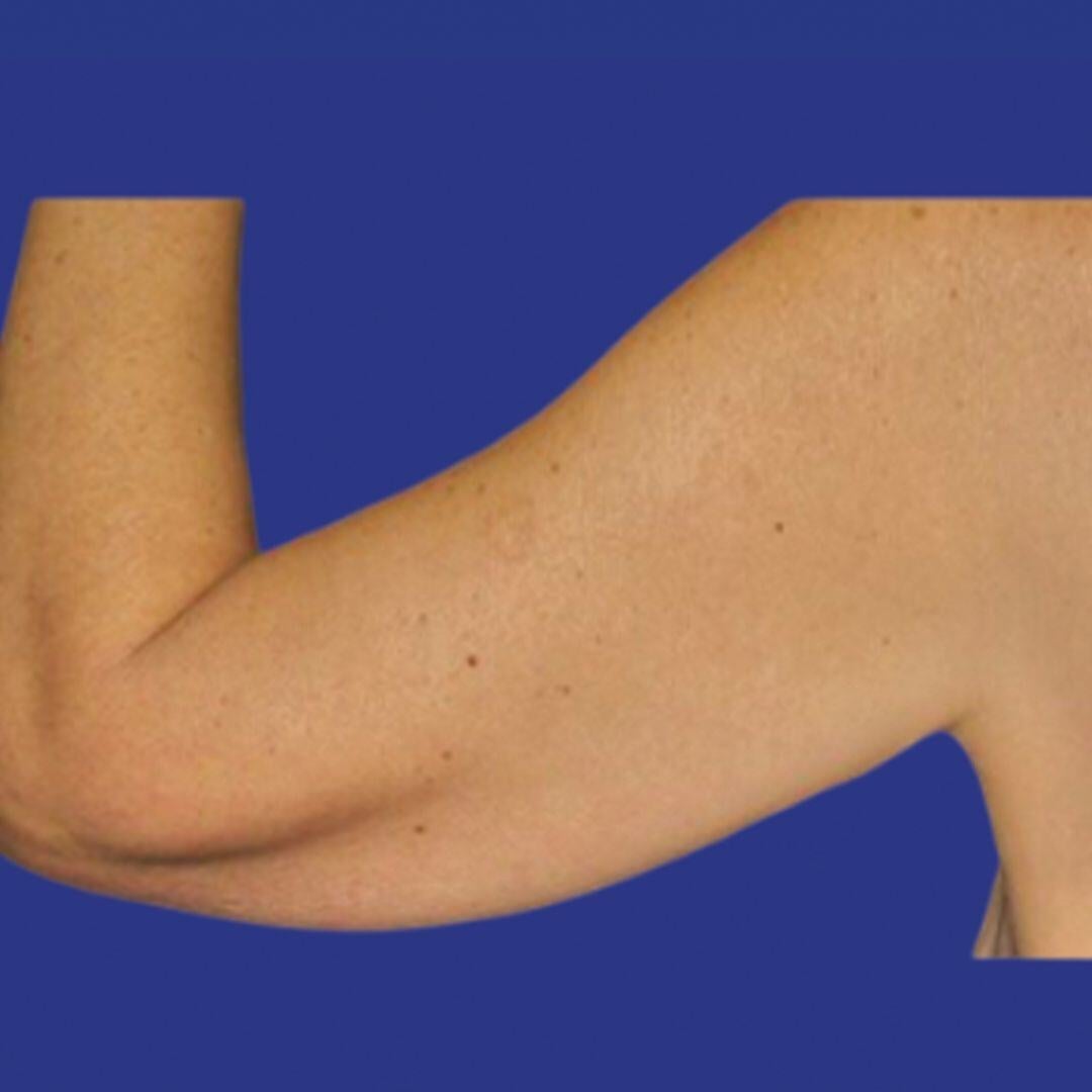 Procedure before and after - before