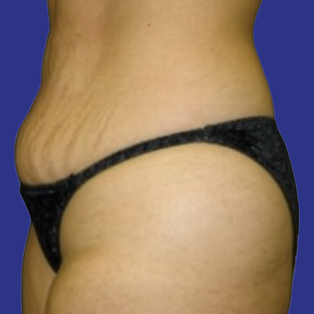 Procedure before and after - before