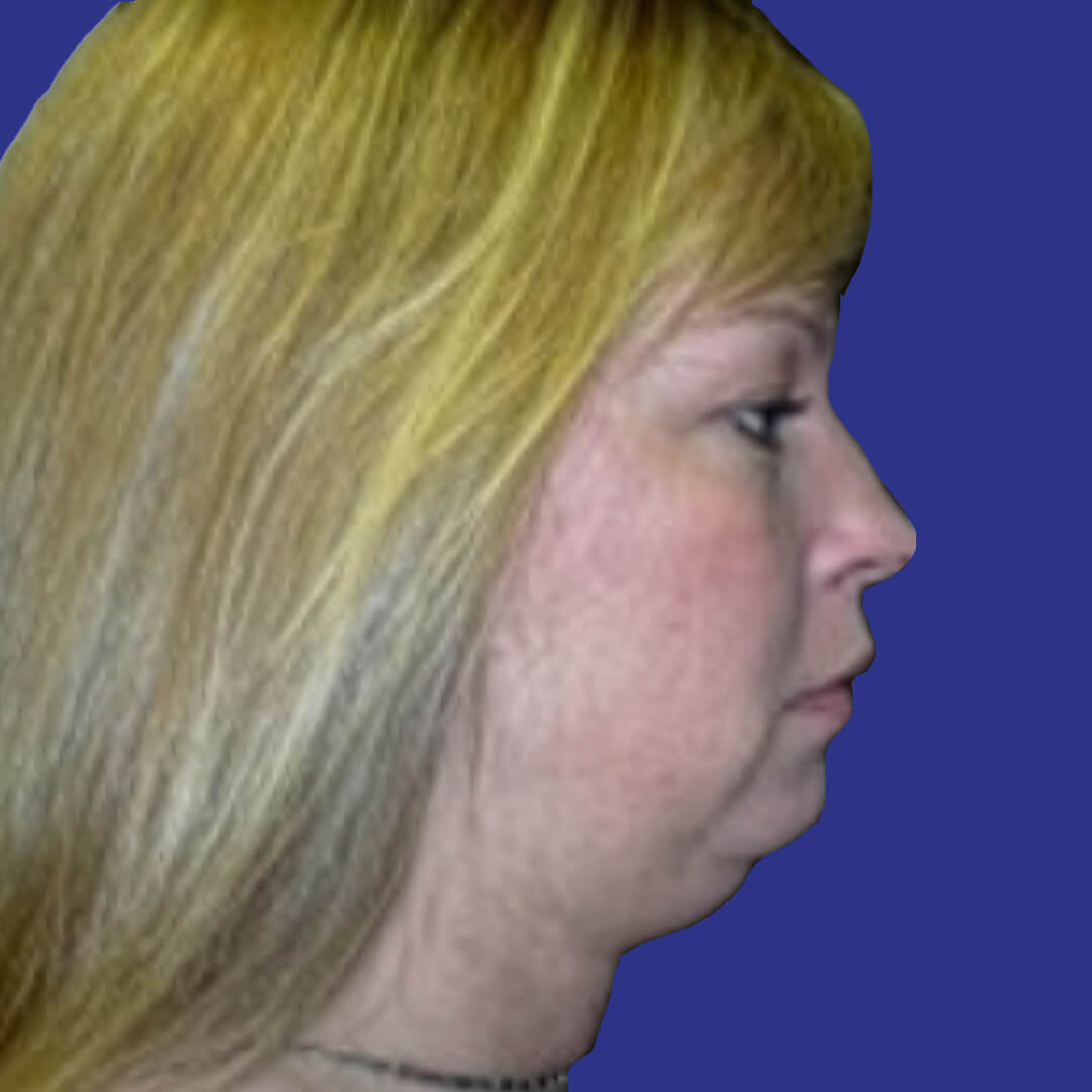 Procedure before and after - before
