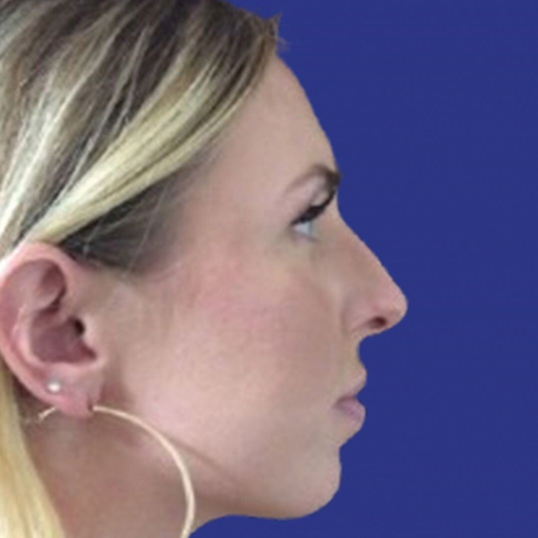 Procedure before and after - before