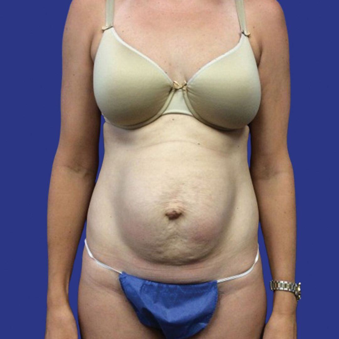Procedure before and after - before