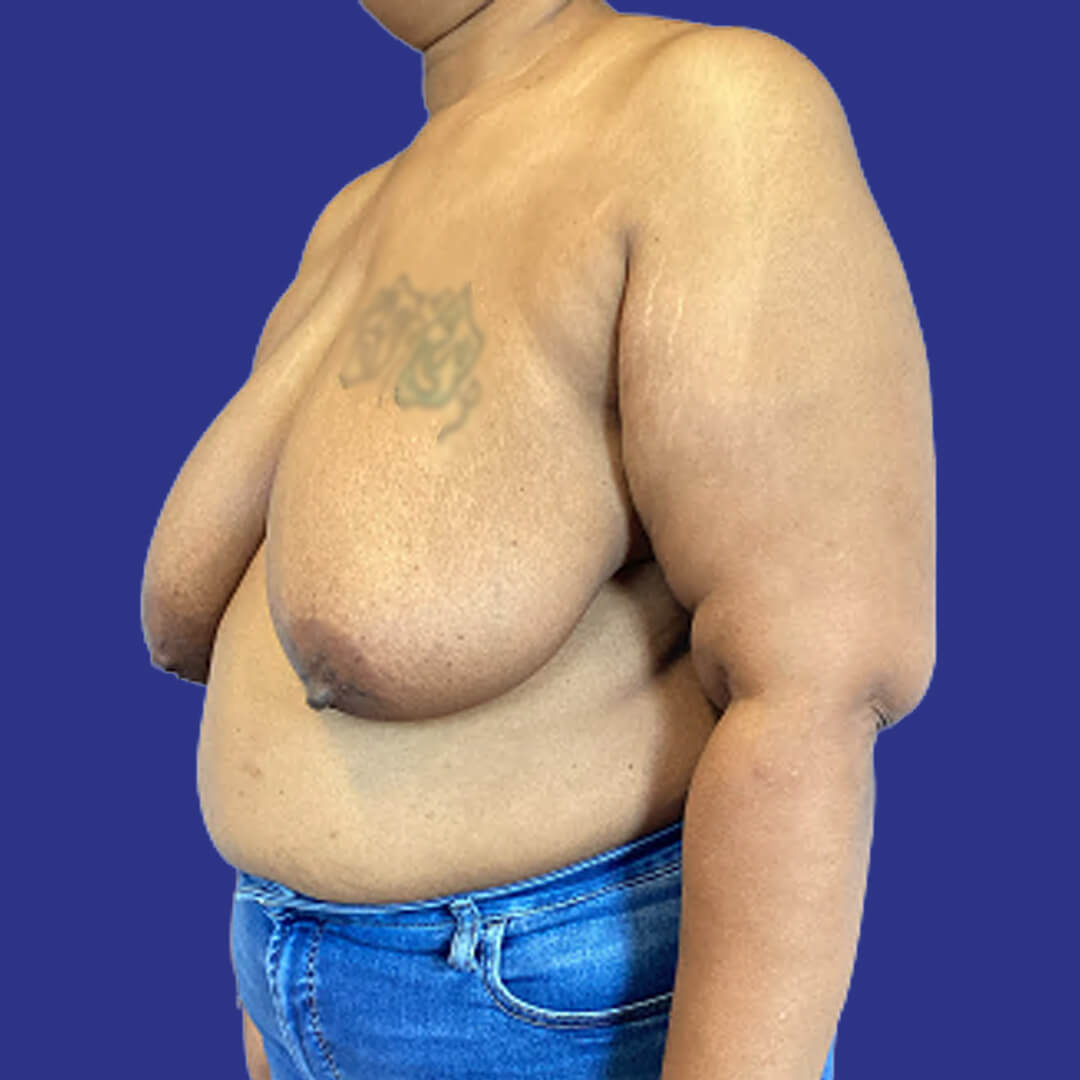 Procedure before and after - before