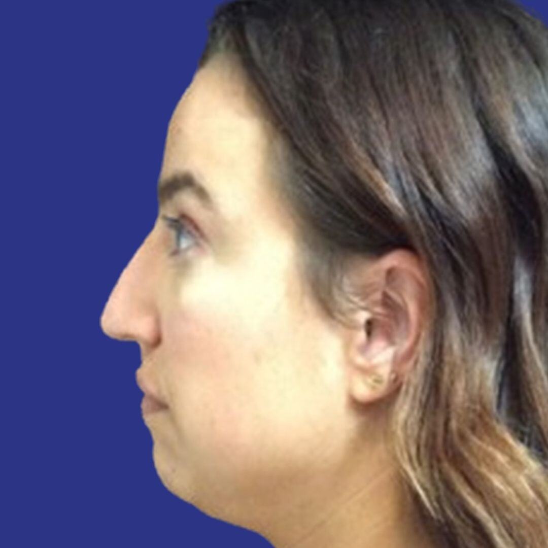 Procedure before and after - before