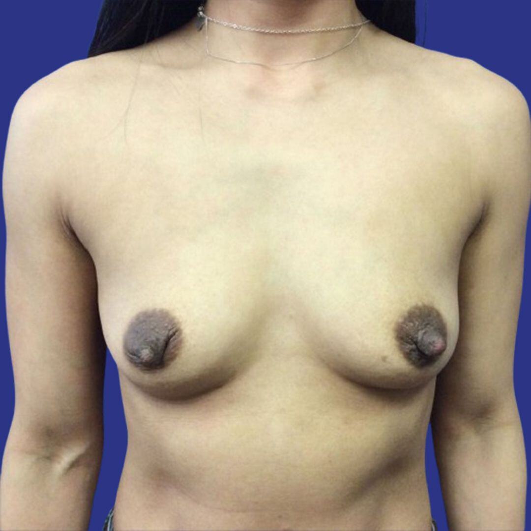 Procedure before and after - before