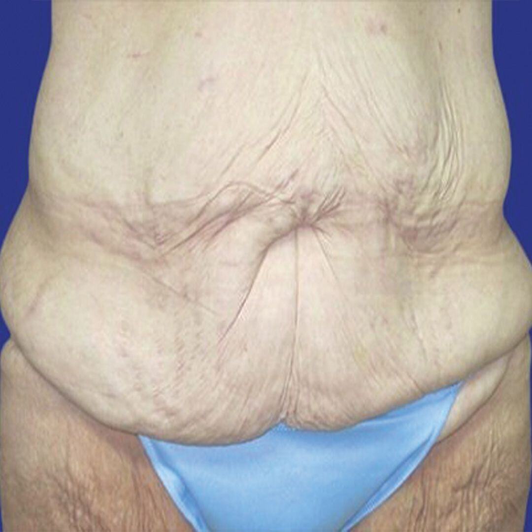 Procedure before and after - before