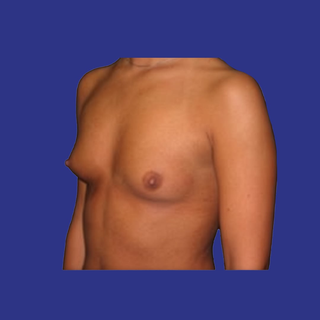Procedure before and after - before