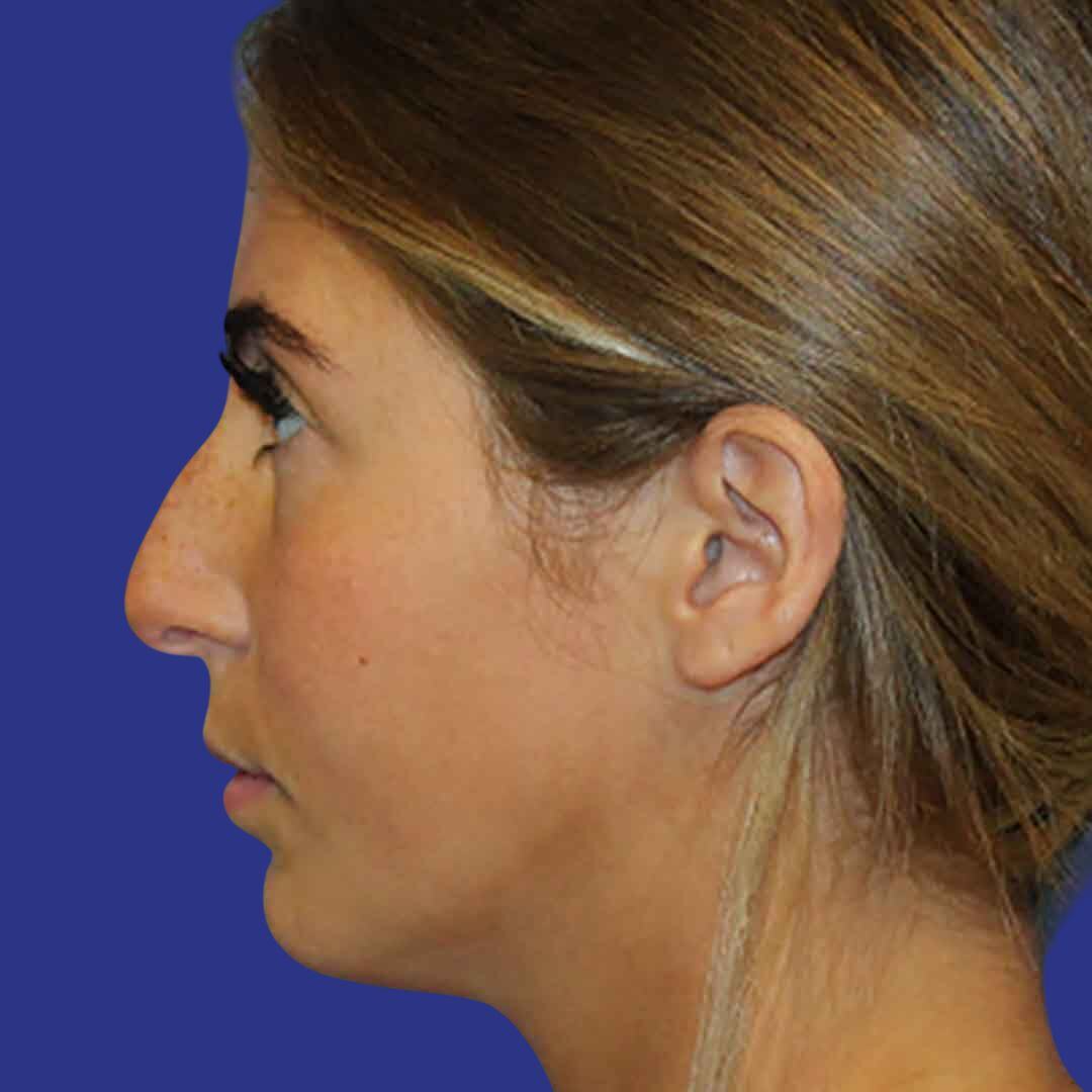 Procedure before and after - before