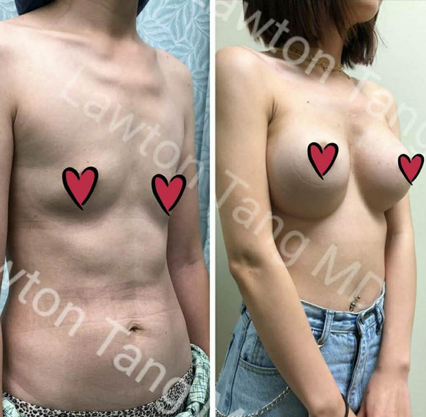 Breast Augmentation / Mommy Makeover before and after - after