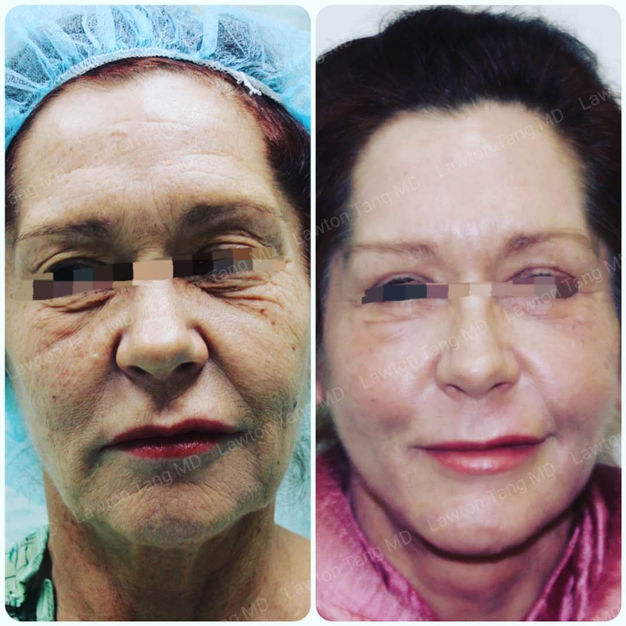 Stem Cell before and after - after