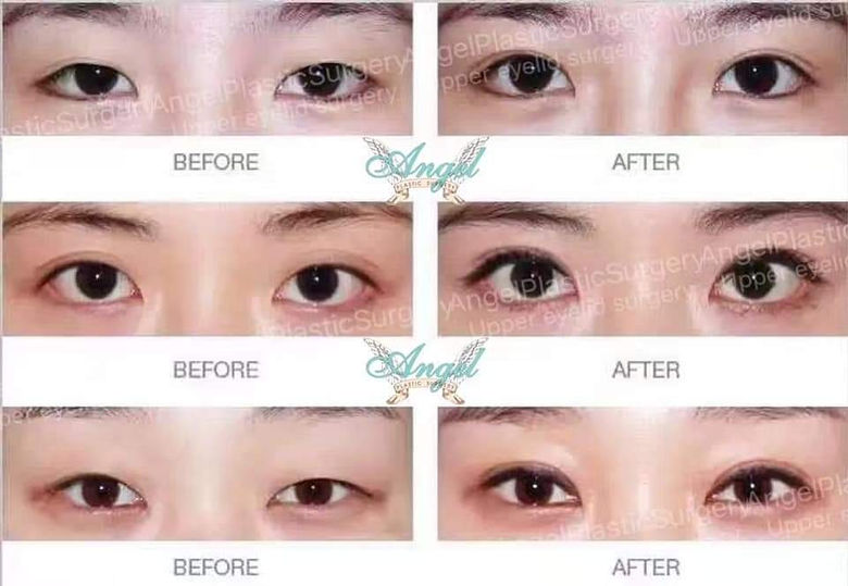 Blepharoplasty (Eyelid Surgery) before and after - after