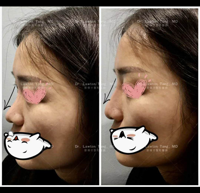 Fillers/Botox before and after - after