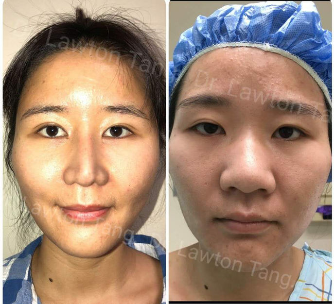 Rhinoplasty (Nose Surgery) before and after - after