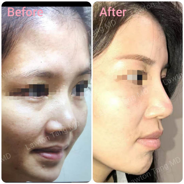 Rhinoplasty (Nose Surgery) before and after - before