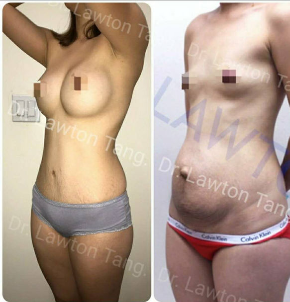 Breast Augmentation / Mommy Makeover before and after - before
