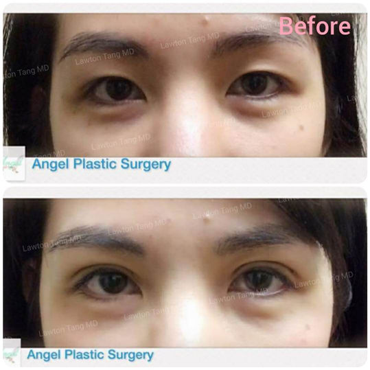 Blepharoplasty (Eyelid Surgery) before and after - before