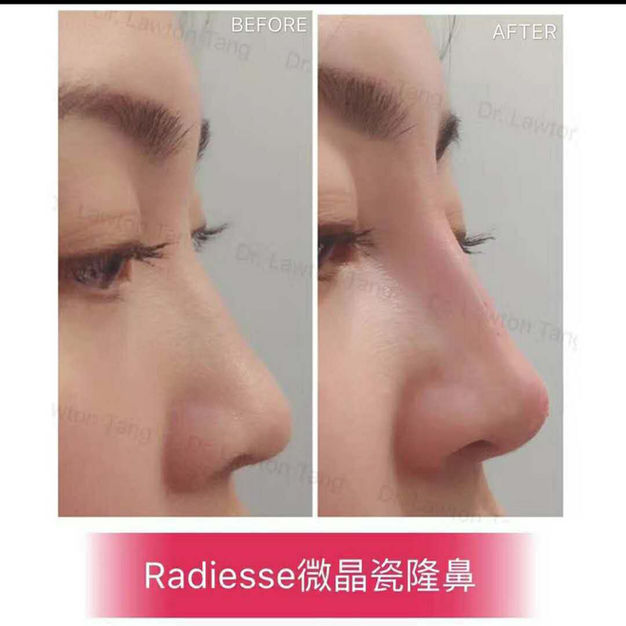 Fillers/Botox before and after - before
