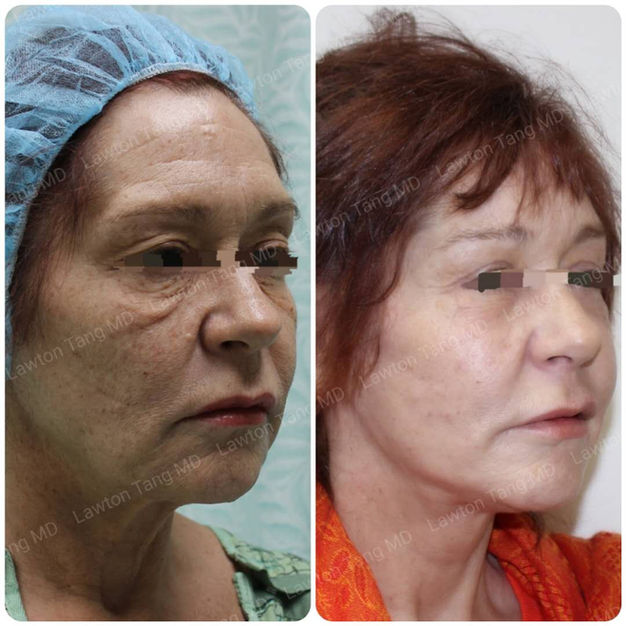 Stem Cell before and after - before