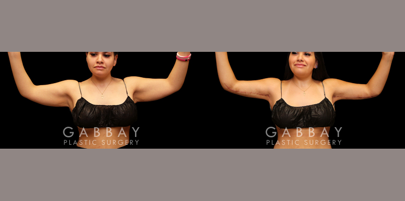 Arm Lift before and after - after