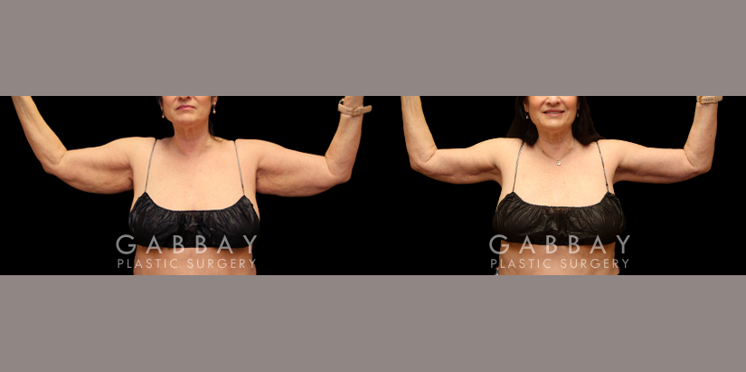 Arm lift with lipo before and after - after