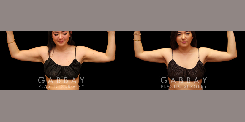 Mini arm lift before and after - after