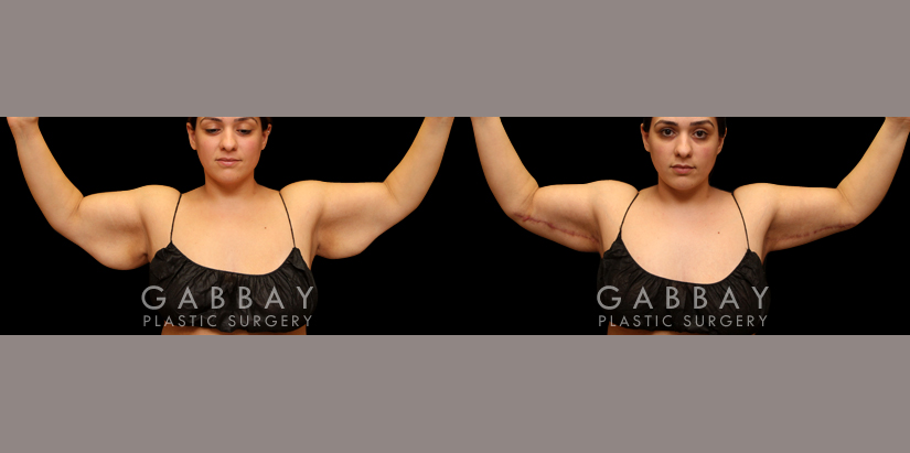 Arm lift with lipo before and after - after