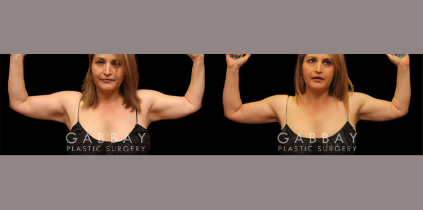 Crecent arm lift, liposuction to arms, j plasma to arms before and after - after