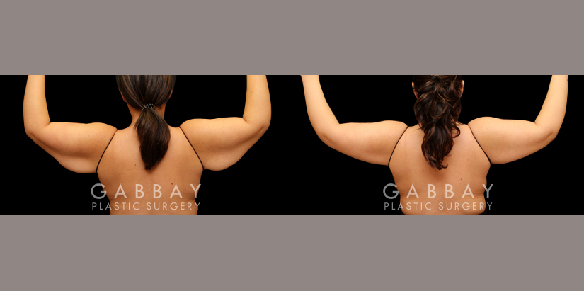 Arm lift with lipo by Dr. Joubin Gabbay — before and after